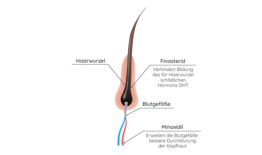 Minoxidil gegen Haarausfall - Wirkung