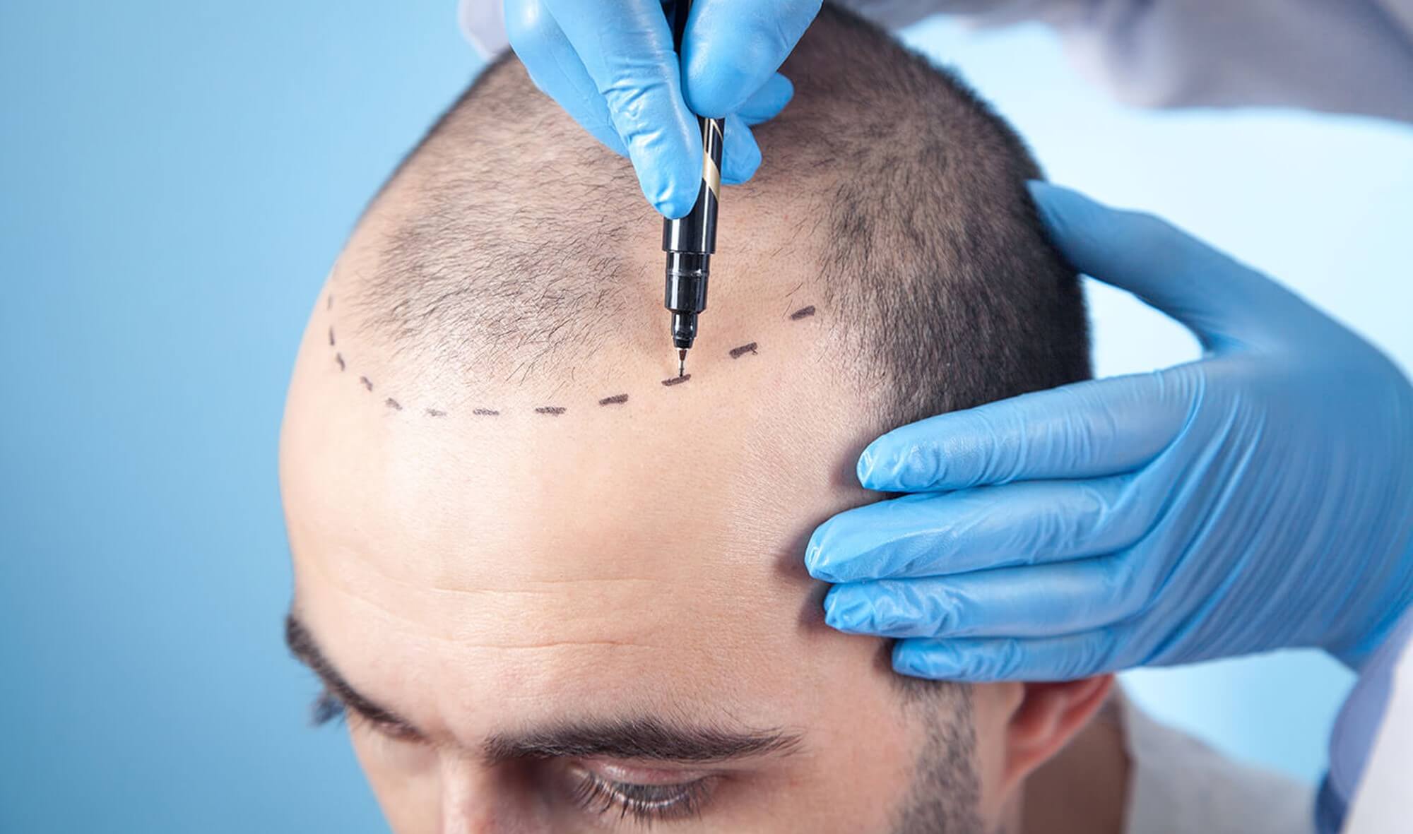 Was Du als Mann über das Transplantieren von Haaren wissen musst Fragen zur Haartransplantation