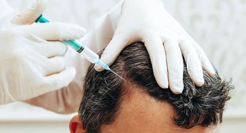 Volles, gesundes Haar durch eine Haartransplantation