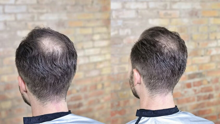 Herrenfrisuren bei Tonsur oder Haarkranz